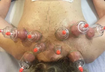 עיסוי רפואי כוסות רוח