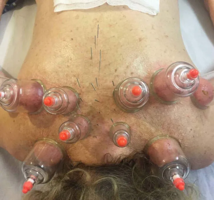 עיסוי רפואי כוסות רוח